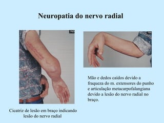 Neuropatia do nervo radial Cicatriz de lesão em braço indicando lesão do nervo radial  Mão e dedos caídos devido a fraqueza do m. extensores do punho e articulação metacarpofalangiana devido a lesão do nervo radial no braço.  