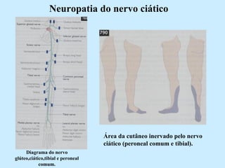Neuropatia do nervo ciático Diagrama do nervo glúteo,ciático,tibial e peroneal comum. Área da cutâneo inervado pelo nervo ciático (peroneal comum e tibial). 
