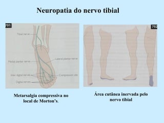 Neuropatia do nervo tibial Metarsalgia compressiva no local de Morton’s . Área cutânea inervada pelo nervo tibial 