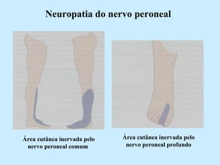 Neuropatia do nervo peroneal Área cutânea inervada pelo nervo peroneal comum  Área cutânea inervada pelo nervo peroneal profundo 