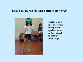 Lesão do nervo fibular comum por PAF   A criança de 8 anos chorava à noite por dor tipo lancinante na face lateral da perna e dorso do pé . 