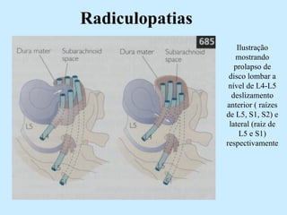 Radiculopatias Ilustração mostrando prolapso de disco lombar a nível de L4-L5 deslizamento anterior ( raízes de L5, S1, S2) e lateral (raiz de L5 e S1) respectivamente 