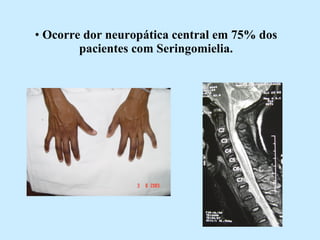 Ocorre dor neuropática central em 75% dos pacientes com Seringomielia. 