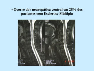Ocorre dor neuropática central em 28% dos pacientes com Esclerose Múltipla 