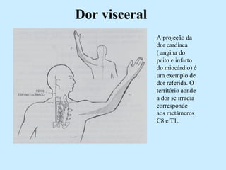 Dor visceral A projeção da dor cardíaca ( angina do peito e infarto do miocárdio) é um exemplo de dor referida. O território aonde a dor se irradia corresponde aos metâmeros C8 e T1. 