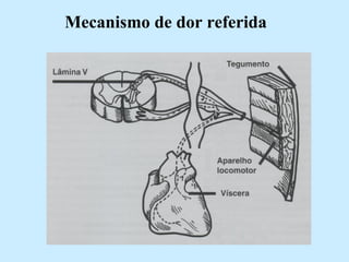 Mecanismo de dor referida 