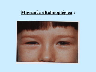 Migranêa oftalmoplégica  : 