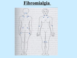 Fibromialgia  