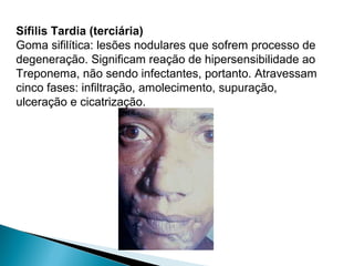 Sífilis Tardia (terciária)
Goma sifilítica: lesões nodulares que sofrem processo de
degeneração. Significam reação de hipersensibilidade ao
Treponema, não sendo infectantes, portanto. Atravessam
cinco fases: infiltração, amolecimento, supuração,
ulceração e cicatrização.
 
