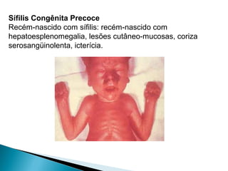 Sífilis Congênita Precoce
Recém-nascido com sífilis: recém-nascido com
hepatoesplenomegalia, lesões cutâneo-mucosas, coriza
serosangüinolenta, icterícia.
 