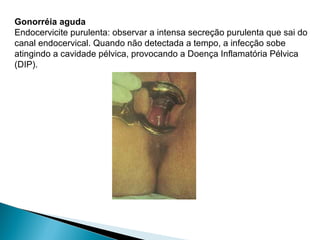 Gonorréia aguda
Endocervicite purulenta: observar a intensa secreção purulenta que sai do
canal endocervical. Quando não detectada a tempo, a infecção sobe
atingindo a cavidade pélvica, provocando a Doença Inflamatória Pélvica
(DIP).
 
