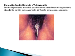 Gonorréia Aguda: Cervicite e Vulvovaginite
Secreção purulenta em vulva: quadros como este de secreção purulenta
abundante, devida exclusivamente à infecção gonocócica, são raros.
 