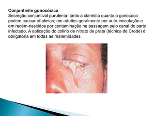 Conjuntivite gonocócica
Secreção conjuntival purulenta: tanto a clamídia quanto o gonococo
podem causar oftalmias; em adultos geralmente por auto-inoculação e
em recém-nascidos por contaminação na passagem pelo canal do parto
infectado. A aplicação do colírio de nitrato de prata (técnica de Credè) é
obrigatória em todas as maternidades.
 