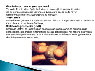 Quanto tempo demora para aparecer?
Varia de 14 a 21 dias. Após l a 3 dias, o homem já se queixa de ardên-
cia ao urinar, seguida por corrimento. Em alguns casos pode haver
febre e outras manifestações gerais de infecção.
SAIBA MAIS
A uretrite não gonocócica pode ser evitada. Por isso é importante usar a camisinha
masculina ou a camisinha feminina.
Uretrite não gonocócica (UNG)
Secreção uretral: as uretrites não gonocócicas, assim como as cervicites não
gonocócicas, são menos sintomáticas que as gonocócicas. Na maioria das vezes
são causadas pela clamídia. Não é raro o achado de infecção mista (gonorréia e
clamídia) em casos como este.
 
