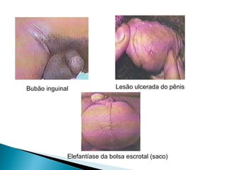 Bubão inguinal Lesão ulcerada do pênis
Elefantíase da bolsa escrotal (saco)
 