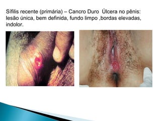 Sífilis recente (primária) – Cancro Duro Úlcera no pênis:
lesão única, bem definida, fundo limpo ,bordas elevadas,
indolor.
 