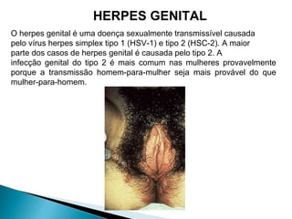 O herpes genital é uma doença sexualmente transmissível causada
pelo vírus herpes simplex tipo 1 (HSV-1) e tipo 2 (HSC-2). A maior
parte dos casos de herpes genital é causada pelo tipo 2. A
infecção genital do tipo 2 é mais comum nas mulheres provavelmente
porque a transmissão homem-para-mulher seja mais provável do que
mulher-para-homem.
HERPES GENITAL
 