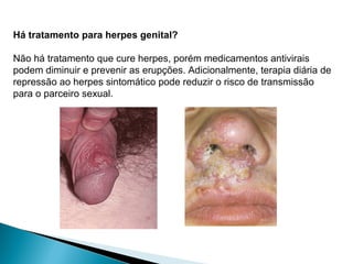 Há tratamento para herpes genital?
Não há tratamento que cure herpes, porém medicamentos antivirais
podem diminuir e prevenir as erupções. Adicionalmente, terapia diária de
repressão ao herpes sintomático pode reduzir o risco de transmissão
para o parceiro sexual.
 