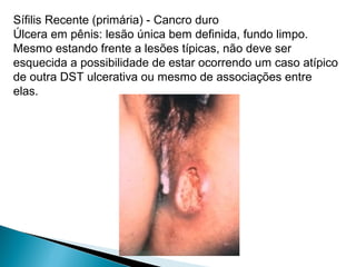 Sífilis Recente (primária) - Cancro duro
Úlcera em pênis: lesão única bem definida, fundo limpo.
Mesmo estando frente a lesões típicas, não deve ser
esquecida a possibilidade de estar ocorrendo um caso atípico
de outra DST ulcerativa ou mesmo de associações entre
elas.
 