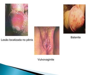 Lesão localizada no pênis
Vulvovaginite
Balanite
 