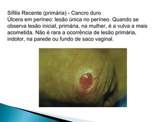 Sífilis Recente (primária) - Cancro duro
Úlcera em períneo: lesão única no períneo. Quando se
observa lesão inicial, primária, na mulher, é a vulva a mais
acometida. Não é rara a ocorrência de lesão primária,
indolor, na parede ou fundo de saco vaginal.
 