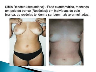 Sífilis Recente (secundária) - Fase exantemática, manchas
em pele de tronco (Roséolas): em indivíduos de pele
branca, as roséolas tendem a ser bem mais avermelhadas.
 