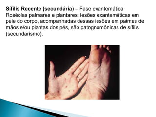 Sífilis Recente (secundária) – Fase exantemática
Roséolas palmares e plantares: lesões exantemáticas em
pele do corpo, acompanhadas dessas lesões em palmas de
mãos e/ou plantas dos pés, são patognomônicas de sífilis
(secundarismo).
 