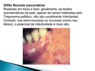 Sífilis Recente (secundária)
Roséolas em boca e face: geralmente, as lesões
exantemáticas da pele, apesar de serem habitadas pelo
Treponema pallidun, não são usualmente infectantes.
Contudo, nas semi-mucosas ou mucosas (como nos
lábios), o potencial de infectividade é mais alto.
 