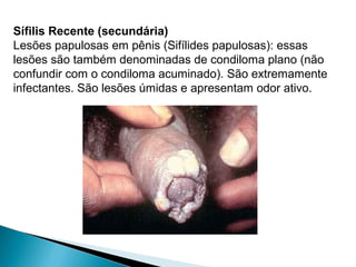 Sífilis Recente (secundária)
Lesões papulosas em pênis (Sifílides papulosas): essas
lesões são também denominadas de condiloma plano (não
confundir com o condiloma acuminado). São extremamente
infectantes. São lesões úmidas e apresentam odor ativo.
 