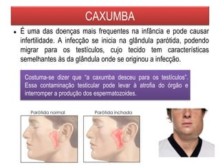 CAXUMBA
● É uma das doenças mais frequentes na infância e pode causar
infertilidade. A infecção se inicia na glândula parótida, podendo
migrar para os testículos, cujo tecido tem características
semelhantes às da glândula onde se originou a infecção.
Costuma-se dizer que “a caxumba desceu para os testículos”.
Essa contaminação testicular pode levar à atrofia do órgão e
interromper a produção dos espermatozoides.
 