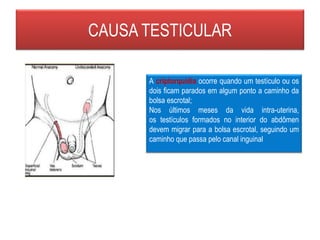 CAUSA TESTICULAR
A criptorquidia ocorre quando um testículo ou os
dois ficam parados em algum ponto a caminho da
bolsa escrotal;
Nos últimos meses da vida intra-uterina,
os testículos formados no interior do abdômen
devem migrar para a bolsa escrotal, seguindo um
caminho que passa pelo canal inguinal
 