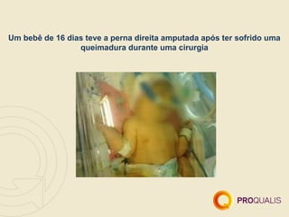 Um bebê de 16 dias teve a perna direita amputada após ter sofrido uma
                 queimadura durante uma cirurgia
 
