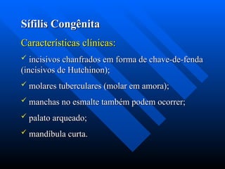 Sífilis Congênita
Sífilis Congênita
Características clínicas:
Características clínicas:
 incisivos chanfrados em forma de chave-de-fenda
incisivos chanfrados em forma de chave-de-fenda
(incisivos de Hutchinon);
(incisivos de Hutchinon);
 molares tuberculares (molar em amora);
molares tuberculares (molar em amora);
 manchas no esmalte também podem ocorrer;
manchas no esmalte também podem ocorrer;
 palato arqueado;
palato arqueado;
 mandíbula curta.
mandíbula curta.
 
