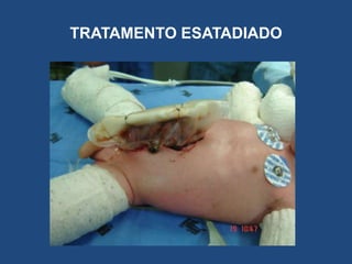 TRATAMENTO ESATADIADO
 