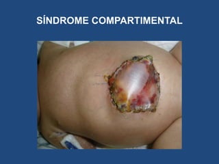 SÍNDROME COMPARTIMENTAL
 