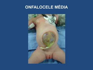 ONFALOCELE MÉDIA
 