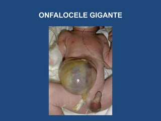 ONFALOCELE GIGANTE
 
