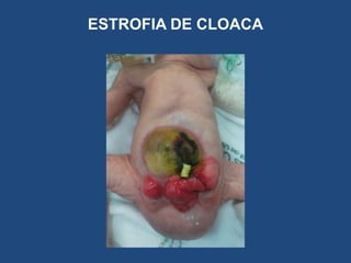ESTROFIA DE CLOACA
 