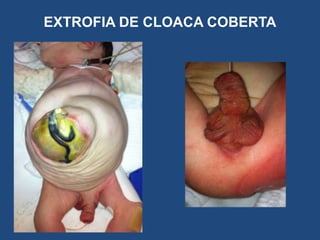 EXTROFIA DE CLOACA COBERTA
 