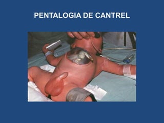 PENTALOGIA DE CANTREL
 