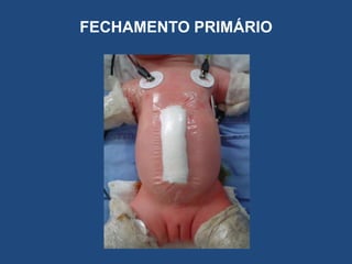 FECHAMENTO PRIMÁRIO
 