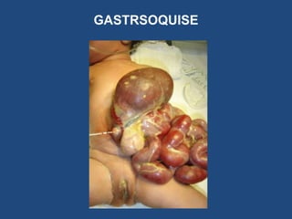 GASTRSOQUISE
 