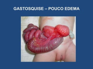 GASTOSQUISE – POUCO EDEMA
 