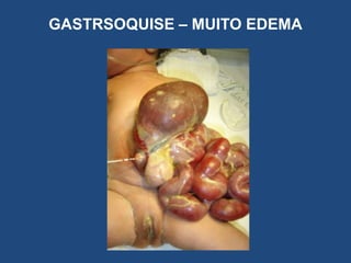 GASTRSOQUISE – MUITO EDEMA
 