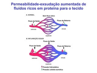 Permeabilidade-exsudação aumentada de fluídos ricos em proteína para o tecido Pressão hidrostática Pressão colóido-osmótic...