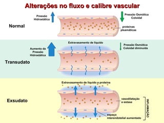 Alterações no fluxo e calibre vascular Normal Pressão Osmótica Coloidal Pressão Hidrostática proteínas plsamáticas Transud...