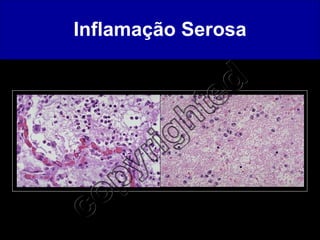 Inflamação Serosa 