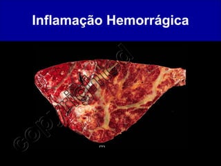 Inflamação Hemorrágica 