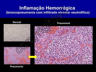 Inflamação Hemorrágica  (broncopneumonia com infiltrado alveolar neutrofílico) Normal Pneumonia Pneumonia 
