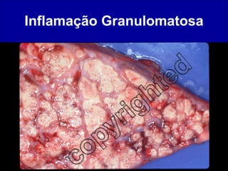 Inflamação Granulomatosa 